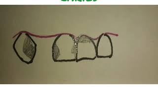 Retainers in Fixed Dental Prosthesis
