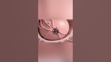 Breast Cancer: How Tumors Begin to Grow