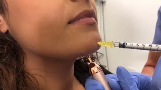 Chin Wrinkles or "Golfball Chin" can be treated with Botox or Dysport