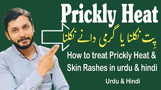 How to treat Prickly Heat & Skin Rashes in urdu & hindi