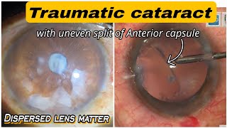 #282 Young Traumatic Cataract with uneven split of anterior capsule &amp; dispersed lens matter