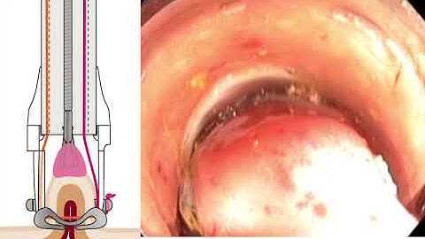 Ovesco FTRD - Procedural Steps