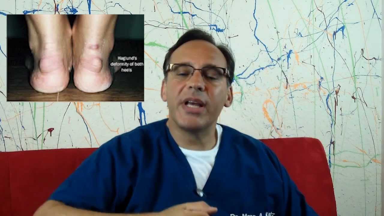 Acupuncture for heel spurs and plantar fasciitis