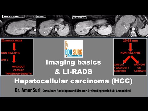 Imaging for Liver Cancer & LI-RADS -Hepatocellular carcinoma radiology masterclass - Edusurg clinics