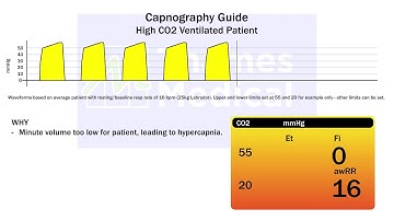 Capnography Waveforms: High Co2 (Ventilated Patient)