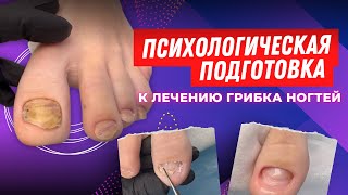 Психологическая подготовка к лечению грибка ногтей / грибок ногтей / лечение #грибок #лечение