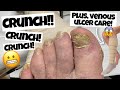 Some Of The CRUNCHIEST Nails We've Ever Seen!! + How To Care For Venous Ulcers!