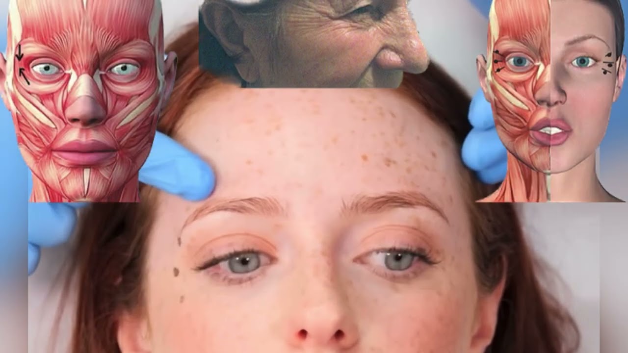 Ботокс ❤️ ботулинотерапия для начинающих ❤️ классическая коррекция токсином зоны межбровья ✅