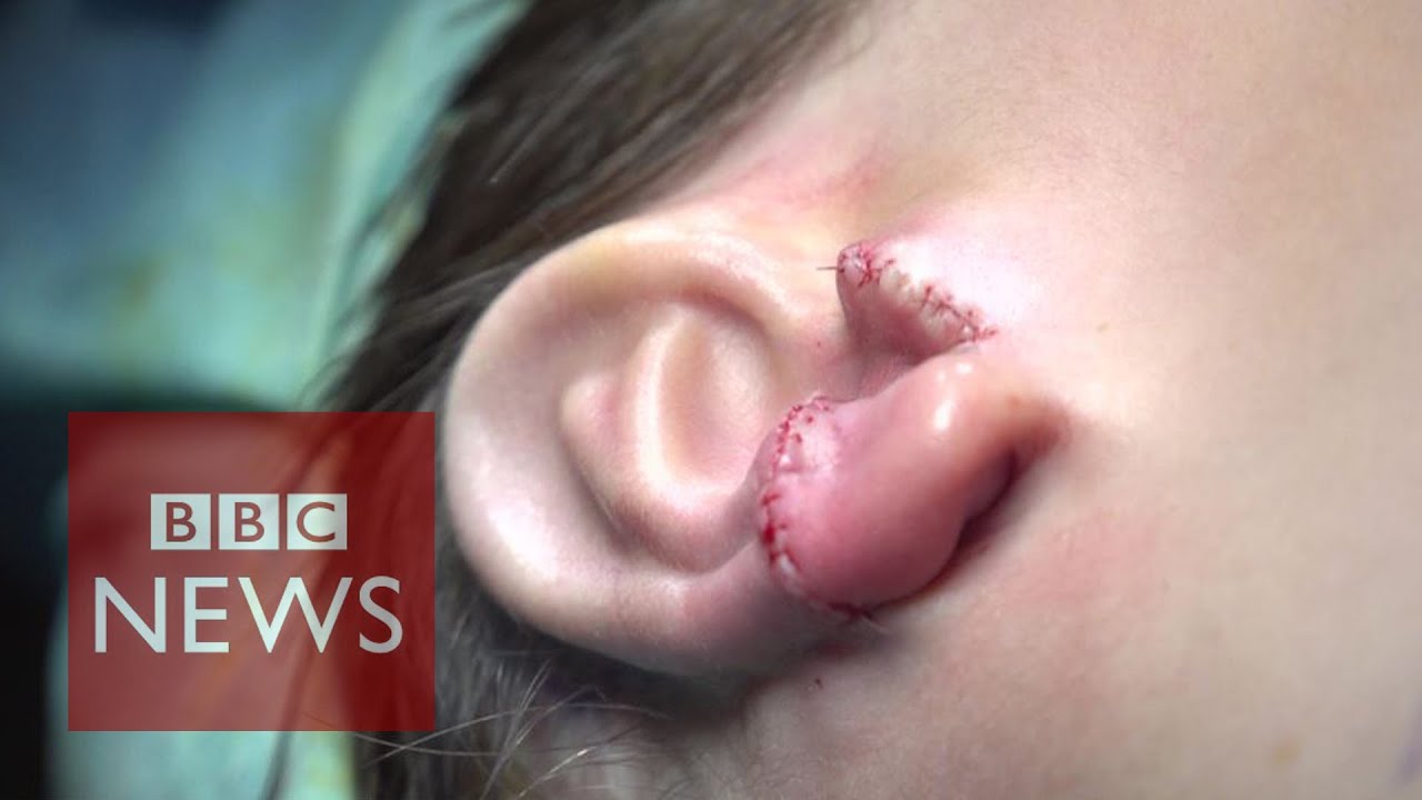 Boy has ears created from his own ribs - BBC News