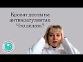 Кровят десны при приёме антикоагулянтов  Что делать?