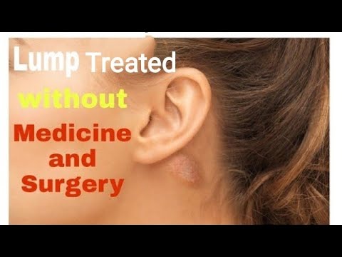 What Causes an Earlobe Bump with pictures