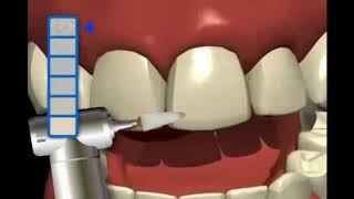 Odstranjivanje Zubne Aproksimalne Gledji