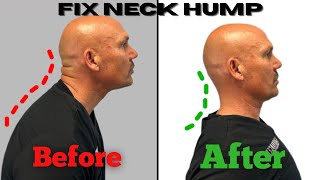 Fix Your Neck Hump FAST (3 Daily Exercises)