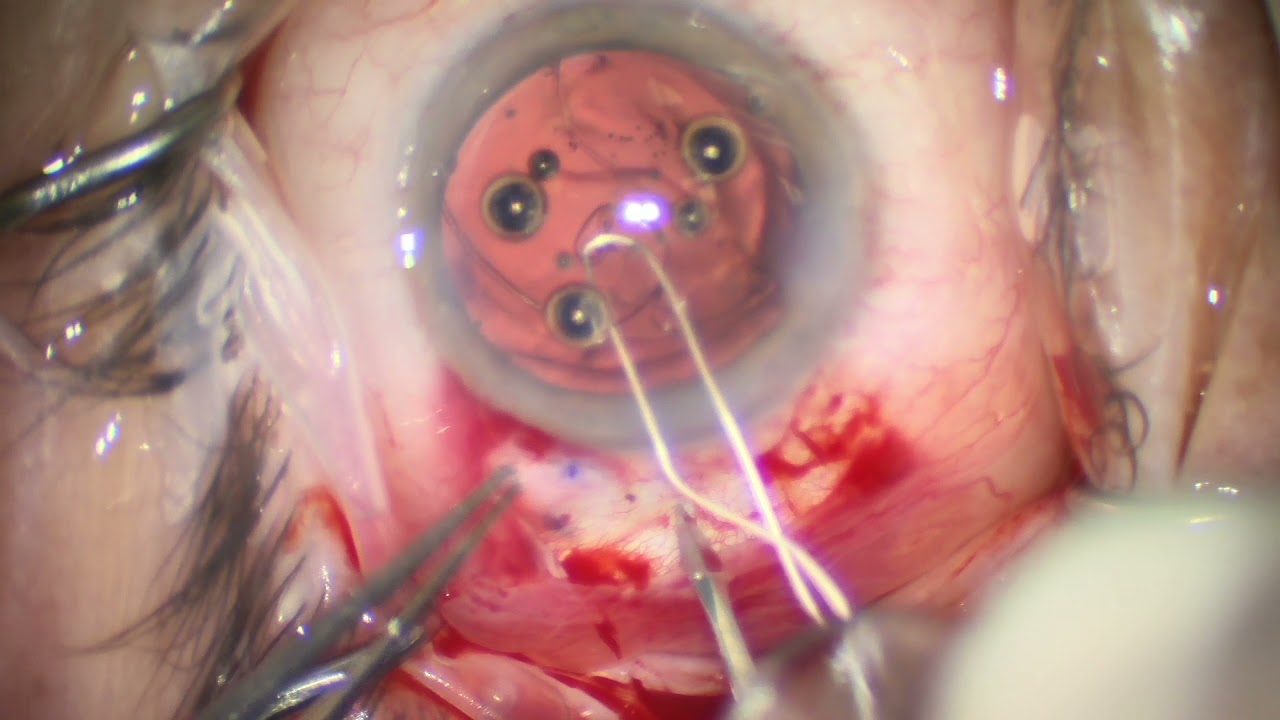 Management of Zonular Dialysis and PC Rent