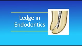What is Ledge in Endodontics
