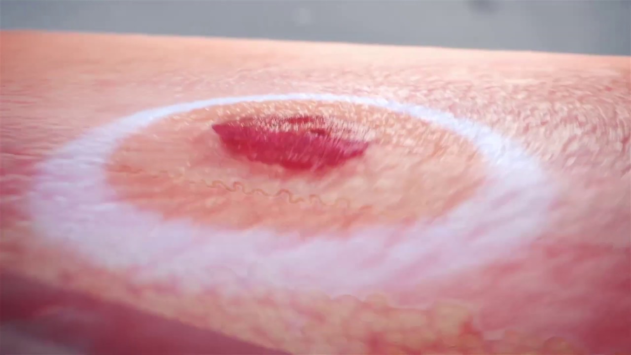 RADiant: Non-Invasive Skin Cancer Treatment