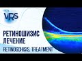 Ретиношизис. Лечение | Retinoschisis. Treatment