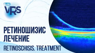 : .  | Retinoschisis. Treatment