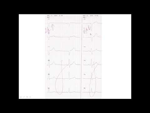 Video: Forskellen Mellem EEG Og EKG