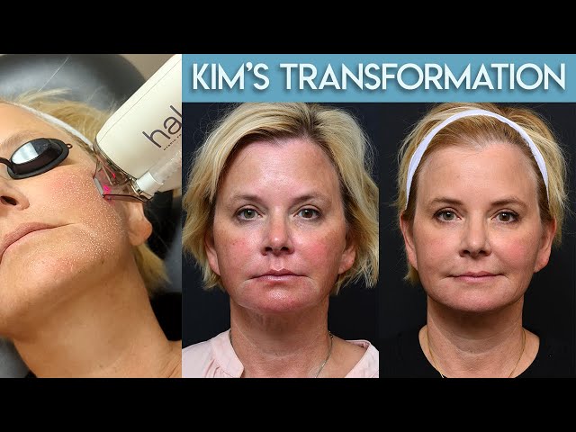 Kim's Hybrid Fractional Laser Transformation