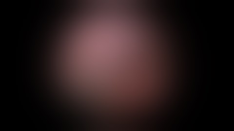 Laparoscopic Renal Pedicle - JustRight 5mm Stapler Highlight Clip