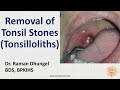 Tonsil Stone Removal - Tonsillolith removal by Dr. Raman Dhungel