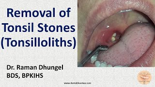 Tonsil Stone Removal - Tonsillolith removal by Dr. Raman Dhungel