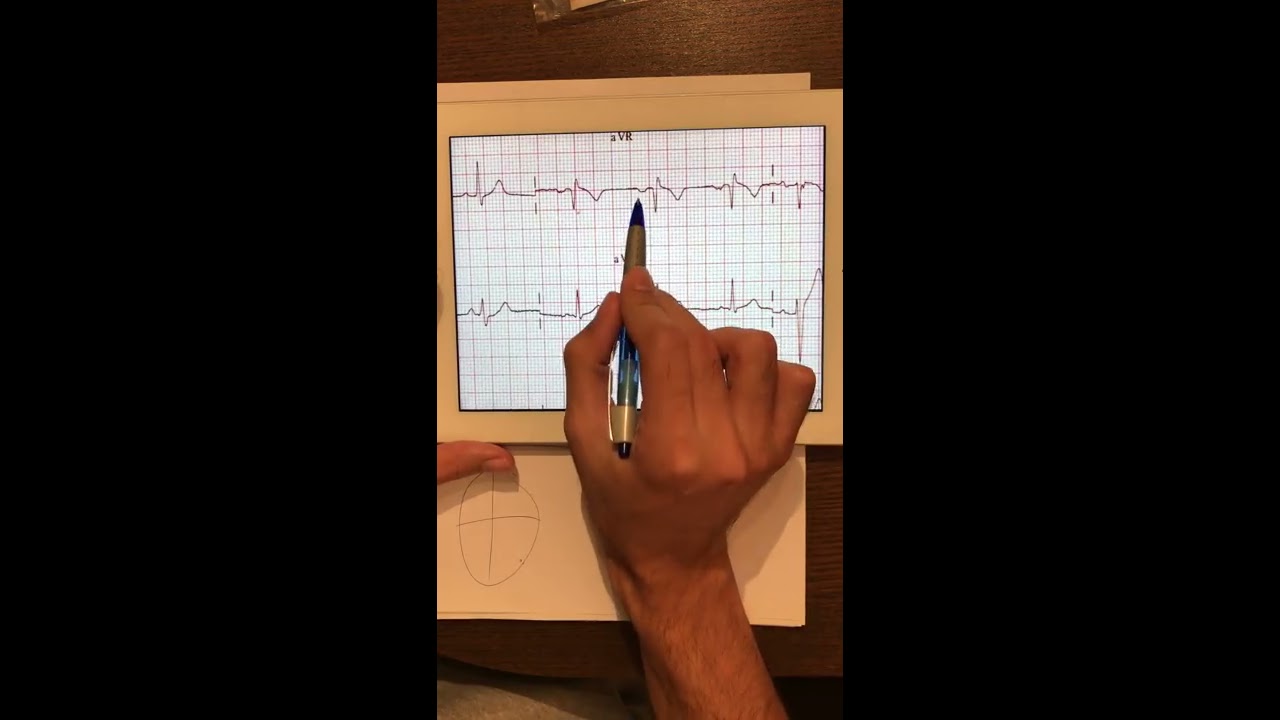 1- normal sinus rhythm