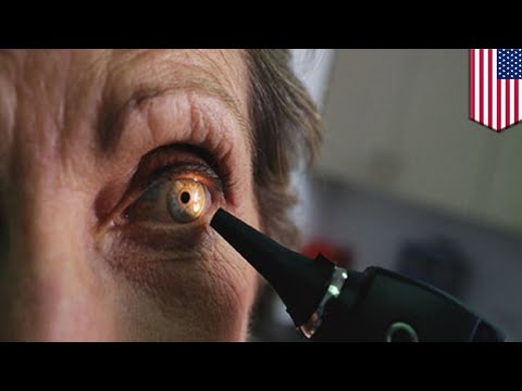日食の目の損傷：日食を見つめた後、女性は三日月形の目の火傷を負います-TomoNews