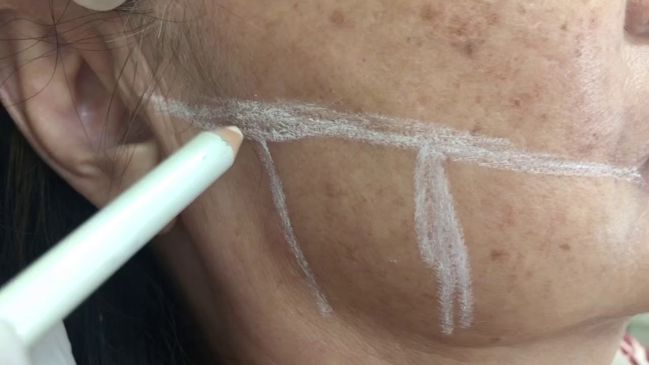 Toxina botulínica para bruxismo