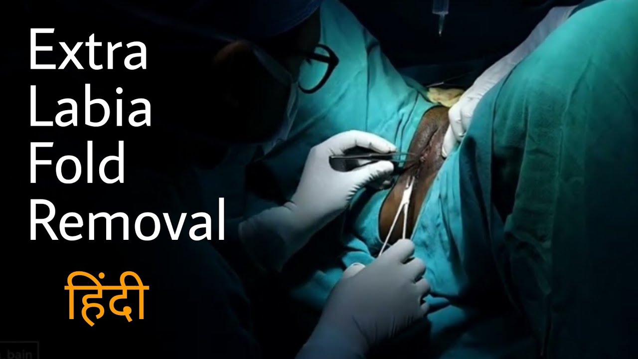 लाबिया फोल्ड रिमूवल Labia Minora Trimming Labia Minoraplasty Best Labiaplasty Surgeon 