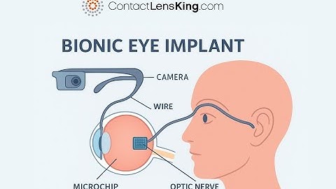 Curing Blindness with Bionic Eye Implants