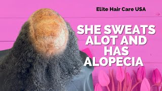 She sweats a lot and has Alopecia | Alopecia weave on mature client