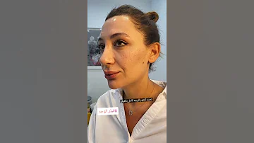 كنتور الوجه كامل بالفيلر تم استخدام ٣ مل فيلر فقطططط 