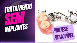 TRATAMENTO SEM IMPLANTE DENTÁRIO -  PROTESE PARCIAL REMOVÍVEL