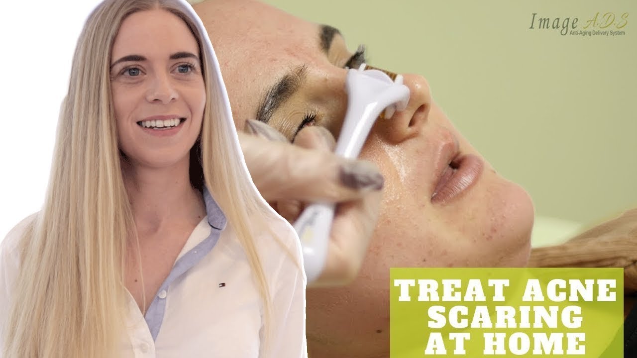 Get Rid Of Acne Scaring QUICKLY! - Derma Rolling With Acne Scars - YouTube