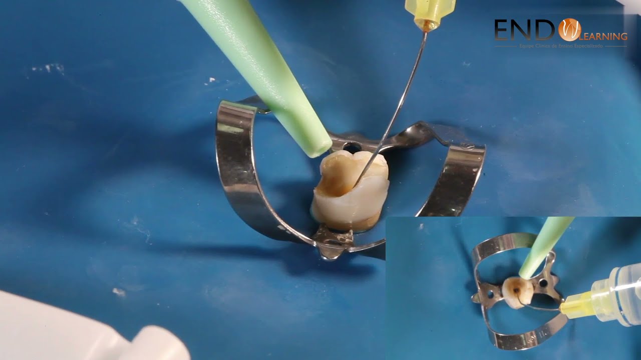 Medicação intracanal - hidróxido de cálcio