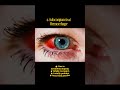 Leukemia ocular manifestations | #optometry #disease #cancer #shorts #neet #doctor #leukemia