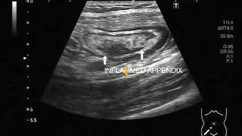 Ultrasound Video showing Appendicular abscess.