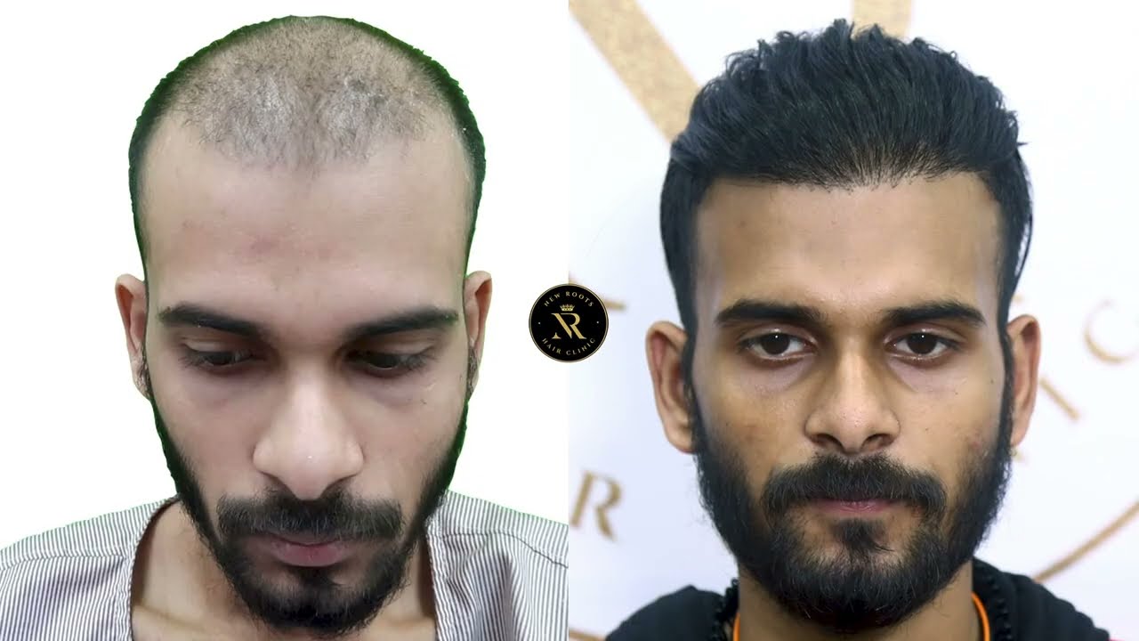 Best Hair Transplant in Kolkata for Long-Lasting Results | New Roots Hair Transplant Centre