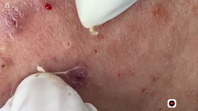 Big Cystic Acne Blackheads Extraction Blackheads & Milia, Whiteheads  Removal Pimple Popping - YouTube