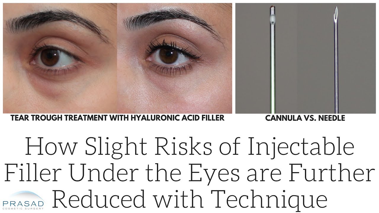 Download How Slight Risks of Injectable Under Eye Fillers are Further Reduced with Experience and Technique
