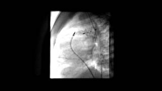 Large PDA   ADO II release across the ductus  Lateral view