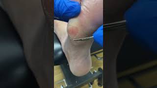 Dive Into The Satisfying World Of Professional Callus Removal Down Under!