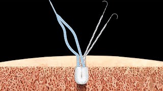 Distal MCL Repair Using Knee FiberTak® Anchors and the InternalBrace™ Technique