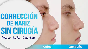 ¿Cómo puedo enderezar mi nariz de forma natural?