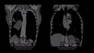 Recognizing Lung Cancer on CT Scans