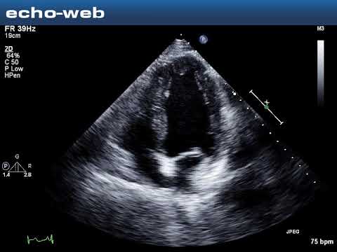 The EchoWeb - Patient Diagnosed with LV Diastolic Dysfunction and Reduced  EF 