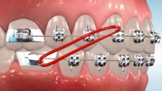 Class 2 Elastics - Easton Ortho 101 with Dr. Loftus Information