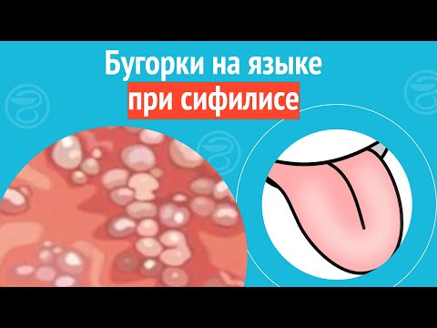 👅 Бугорки на языке при сифилисе. Клинический случай №1079